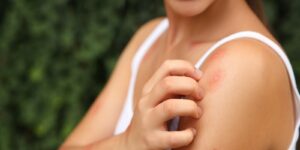A bite of a summer pest on the left shoulder of a woman